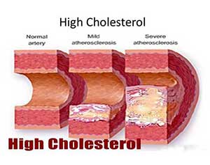 High Cholesterol - Dr. VT Shah
